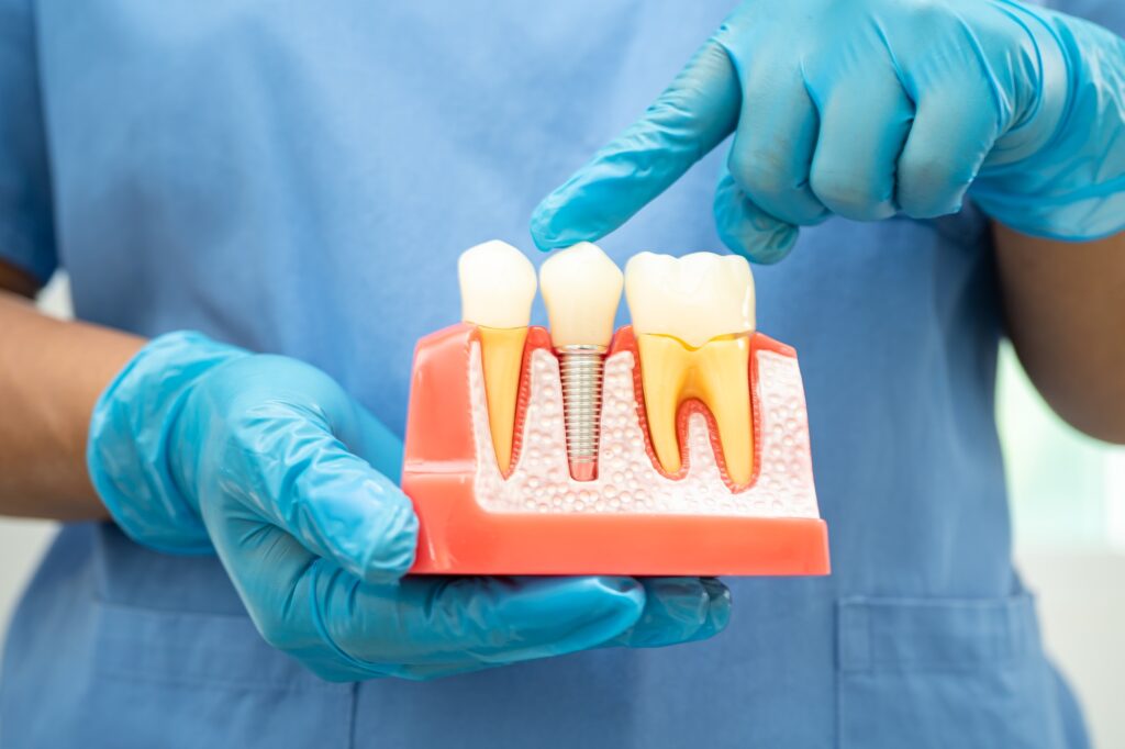 Dental implant, artificial tooth roots into jaw, root canal of dental treatment, gum disease