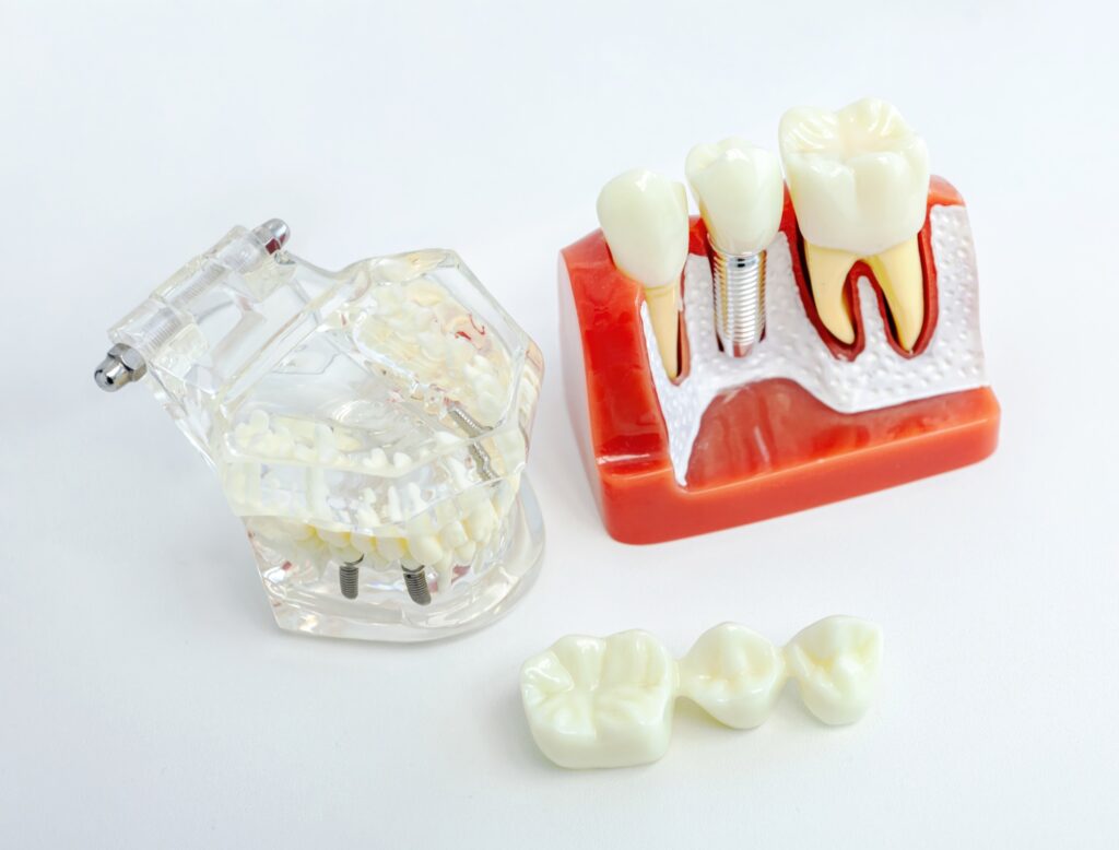 Dental implants and transparent jaw model exhibiting teeth and gums